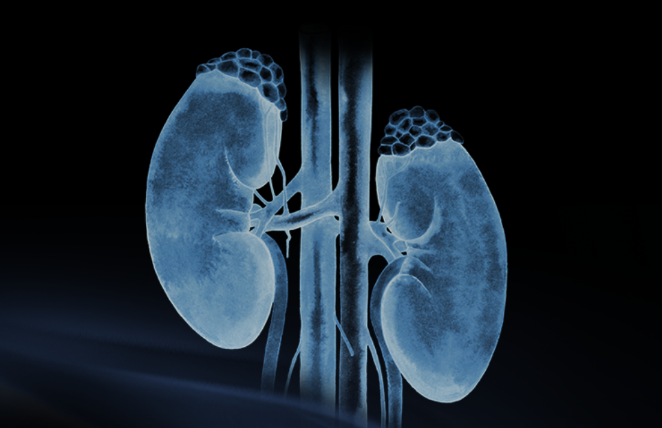 世界腎臟日 | 相得「腎」歡,融有術、精準適形